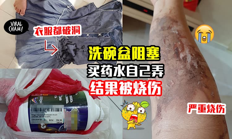 【劝你找专业的来!】大马网友买药水DIY解决「洗碗盆阻塞」结果被烧伤🔥 就连衣服也破洞😱
