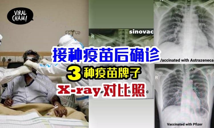 【来看看哪个肺最顶得！】接种科兴、辉瑞及阿斯利康2剂疫苗，确诊后的肺部X光照对比！