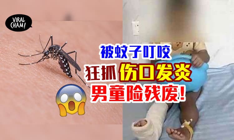 【发炎了很可怕！】被蚊子叮⚡ 5岁男童不小心「抓烂伤口」差点终身残疾！