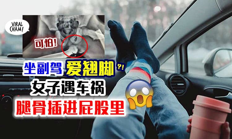 【这个习惯很危险！】女子「坐副驾翘脚」遇上车祸⚡ 整个腿骨插进屁股！