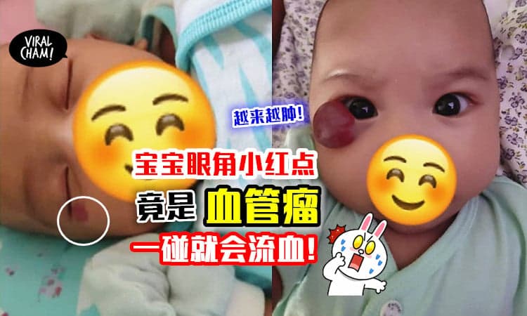 【父母注意了❗】宝宝「眼角小斑点」竟演变成“血管瘤”⚡ 轻轻一摸就会流血！