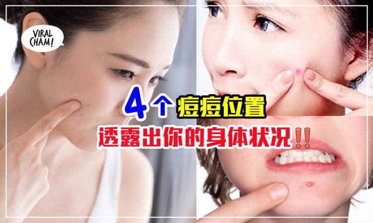 【身体发出求救讯号⚠️】4个冒痘位置隐藏着你的健康问题！内附补救方法~