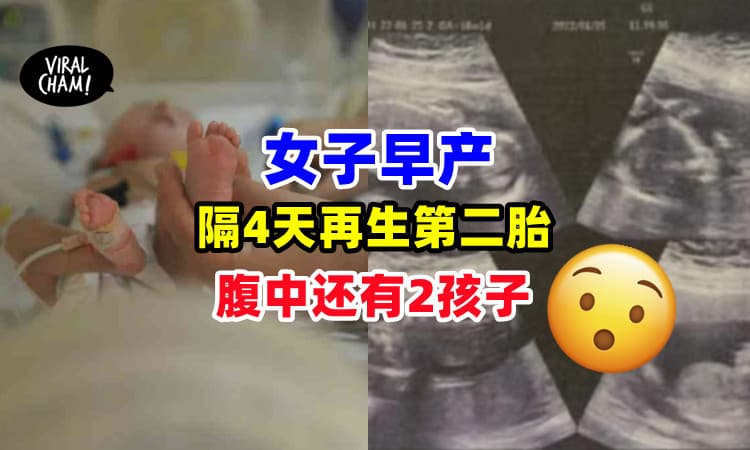 【还有两个孩子在腹中❗️】女子早产生1子, 隔4天后再生第二胎⚡四胞胎罕见不同天出生！