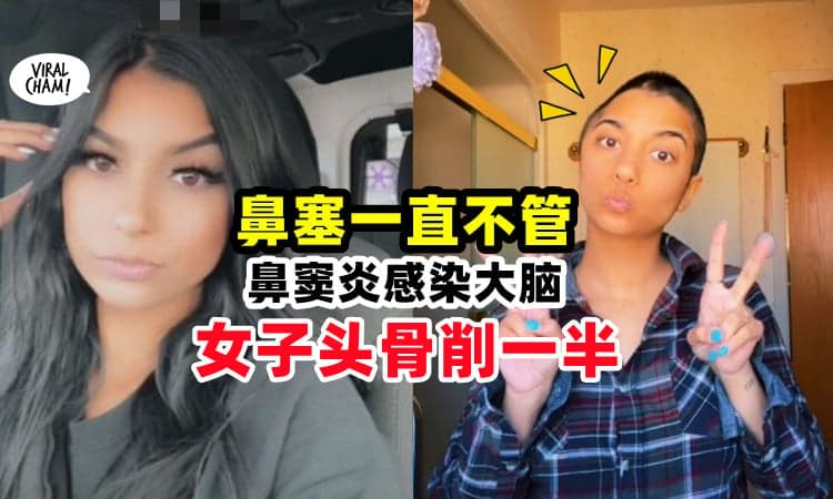 【鼻塞以为是感冒🤧】一拖再拖才发现是鼻窦炎, 最后只好「头骨削一半」保命⚡