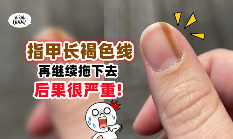【不要小看任何Signal!】女子「指甲长褐色线」拖了10年才检查, 得知惊人结果!