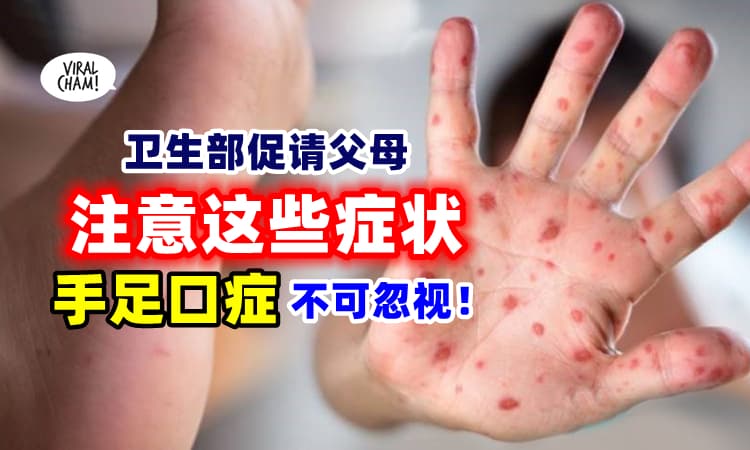 【大马手足口症暴增⚡】卫生部带你『了解症状&留意事项』促请父母早带孩子治疗❗
