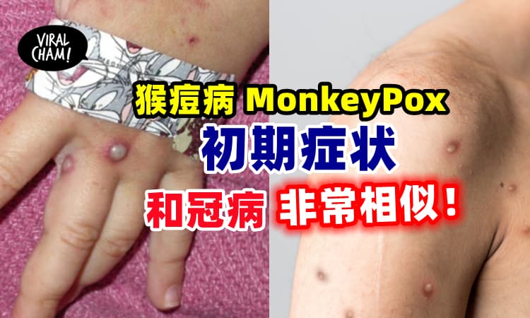 【症状跟Covid很像！】Monkeypox病毒变化曝光⚡开始会发烧,头痛及肌肉疼痛等等！