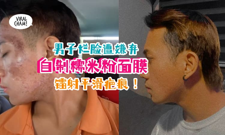【有烂脸烦恼的看过来✨】大马痘痘男分享『RM6.90糯米粉面膜+镭射😍』拯救烂脸❗ (内有影片)