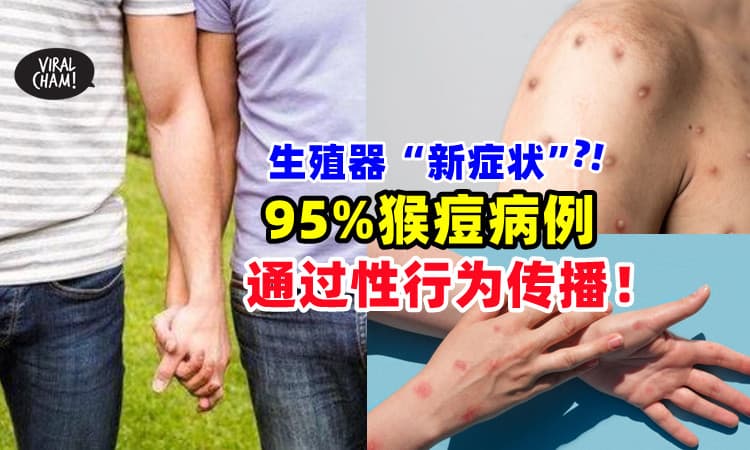 【出现生殖器新症状⁉】研究显示 : 猴痘「95%透过性行为」传播⚡