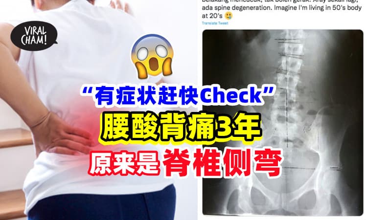 【有症状快去Check❗】年轻女子「腰酸背痛3年」才知脊椎侧弯⚡ 感叹 : 身体像50多岁😥