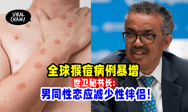 【先冷静冷静！】全球猴痘病例暴增，WHO呼吁男同性恋减少性伴侣！