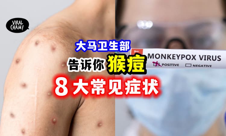 【有点像Covid!】卫生部告诉你「猴痘 8大症状」🐒 一起小心注意!