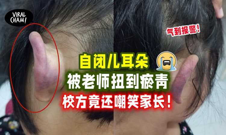 【已报警处理中🔥】自闭儿耳朵被老师扭到瘀青！投诉竟被校方嘲笑！