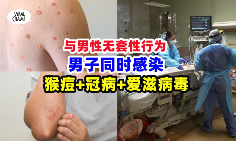 【全世界首例❗】36岁男子『同时感染』猴痘、冠病、爱滋病毒⚡医生都震惊了😱