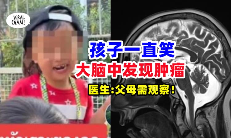 【以为孩子单纯喜欢笑❓ 】孩子『无端端痴笑』医生在大脑发现肿瘤⚡