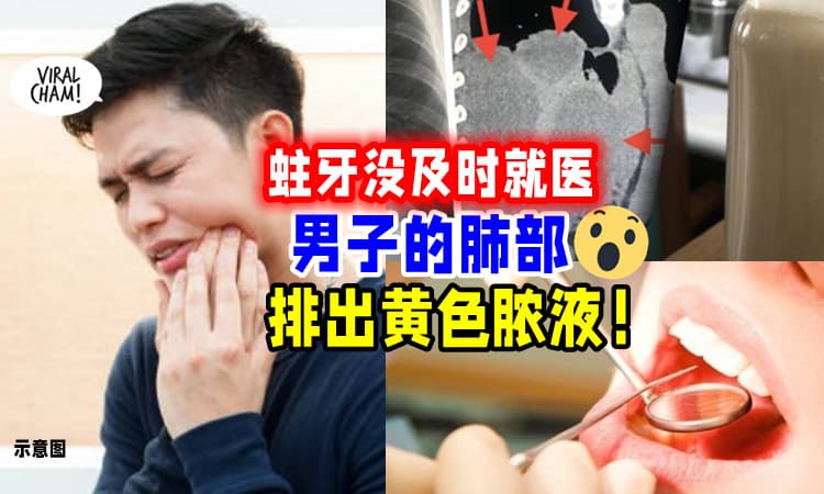【请及时就医❗】男子「忽视蛀牙不处理🦷」肺部竟排出黄色脓液😱