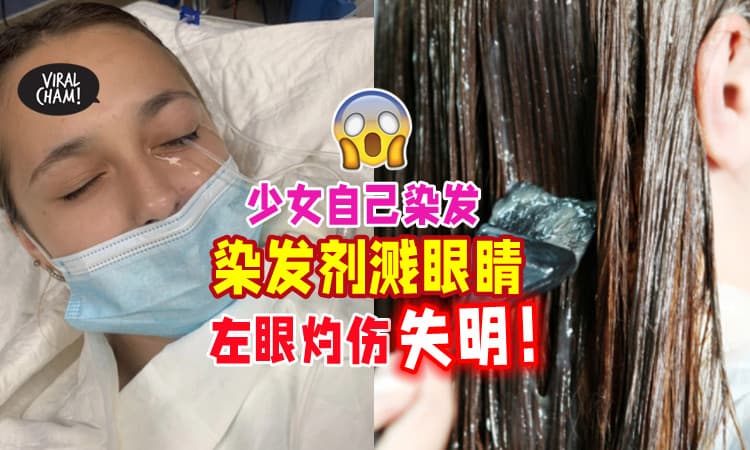 【在家染头注意⚡】13岁少女「染发剂溅到眼睛」左眼三度灼伤🔥 导致失明！