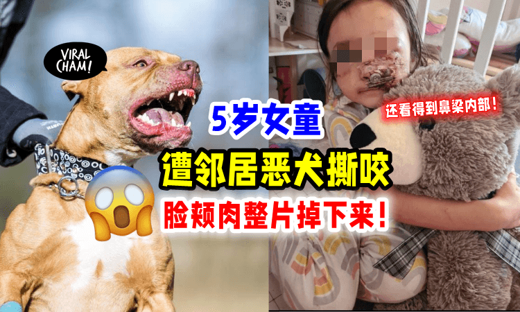 【超痛心😭】5岁女童被「邻居恶犬袭击」整块脸颊肉被撕下😱一生都需接受治疗‼️