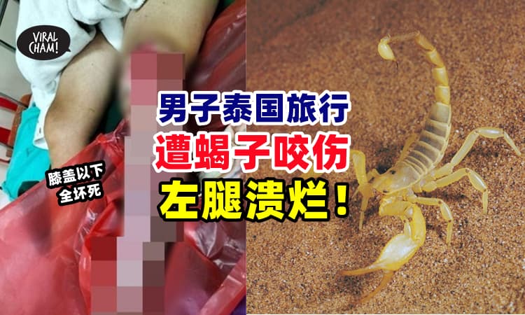 【皮肉被吃光⚡】男子到泰国旅行, 疑遭蝎子咬伤, 整条腿几乎『溃烂消失』❗