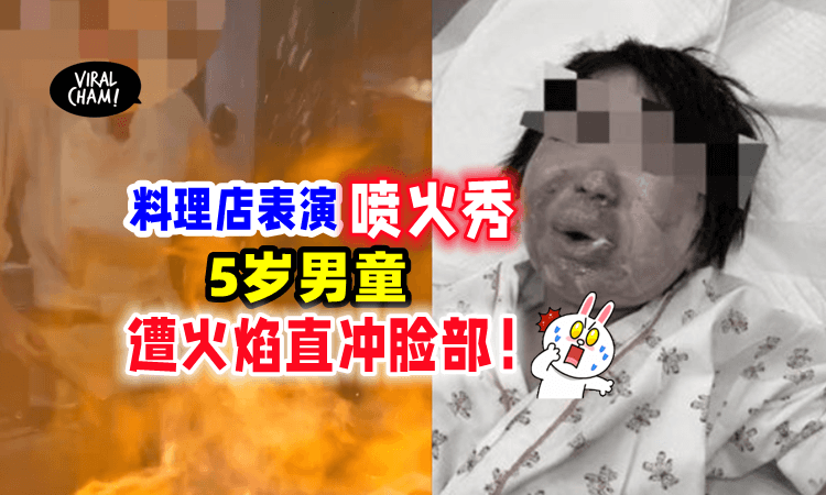 【脸都烧焦了😱】铁板烧店表演「喷火秀🔥」5岁男童惨被严重烧伤❗️（内有影片）