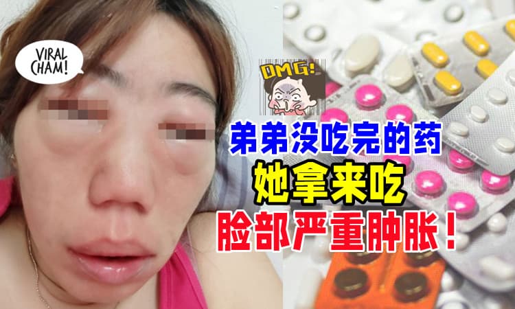 【不能乱乱吃⚡】大马女子「吃弟弟没吃完的药💊」3小时后脸部严重肿胀！