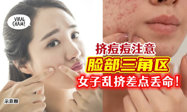 【不要乱挤😥】脸部「危险三角区」挤痘要注意⚡ 女子细菌感染差点送命！