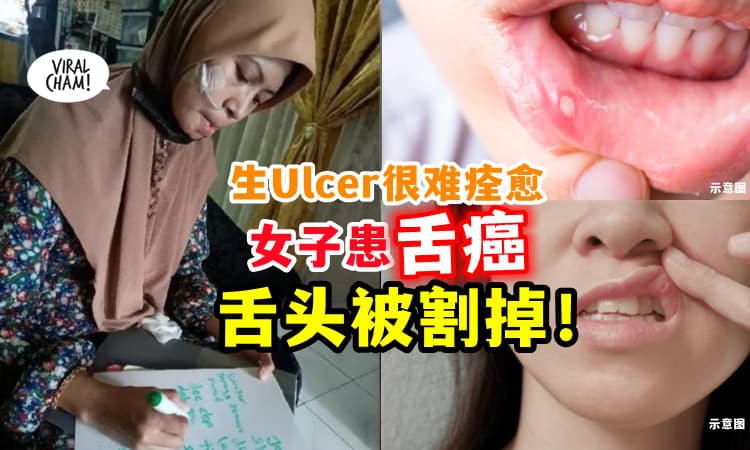 【别以为是小事😱】女子长Ulcer难痊愈⚡被证实患舌癌，需切除舌头！