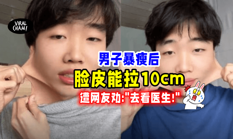 【狂减60kg⚡️】男子的脸皮「拉到10cm长😱」网民惊讶：你可能生病了❗️