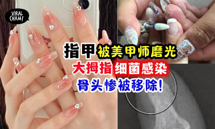 【恐要截掉整个拇指❗️】女子的指甲「遭美甲师磨光」细菌感染惨“去骨”😱