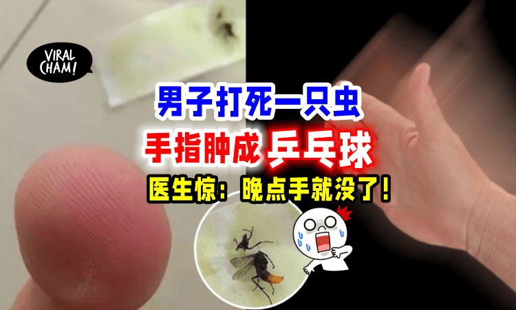 【差点就废掉😱】男子一掌拍死「不明昆虫⚡️」手指竟肿成乒乓球大❗️