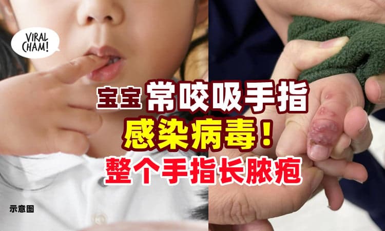 【父母注意了❗】1岁Baby常常「咬吸手指👶」感染病毒长脓疱⚡