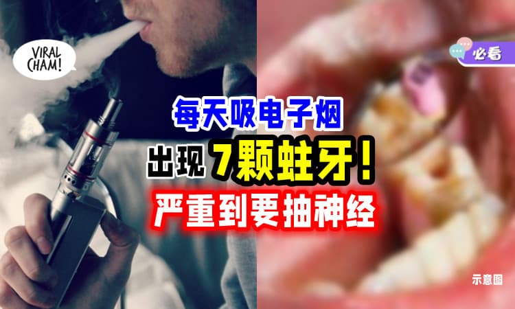 【蛀光光❗】男子每天「抽电子烟」惊现7颗蛀牙🦷 严重到要抽神经！