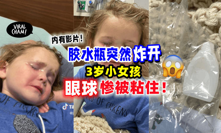 【在眼前炸开😱】3岁女童开胶水瓶「突然”爆炸”💥」双眼惨被死死粘住‼️（内有影片）