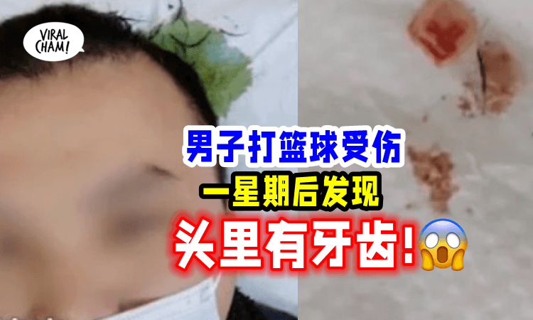 【太吓人了吧❗】头顶出血还「传出腐臭味」去医院发现里面竟藏有牙齿😱