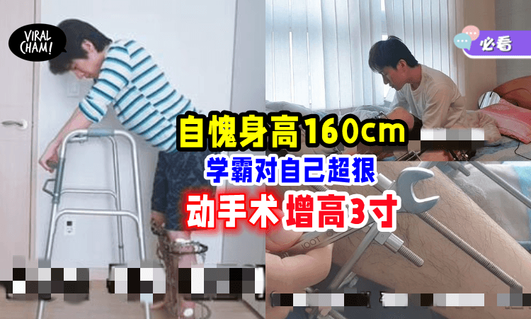 【术后超疼痛⚡】学霸不满「身高160cm」选择动手术增高3寸📈