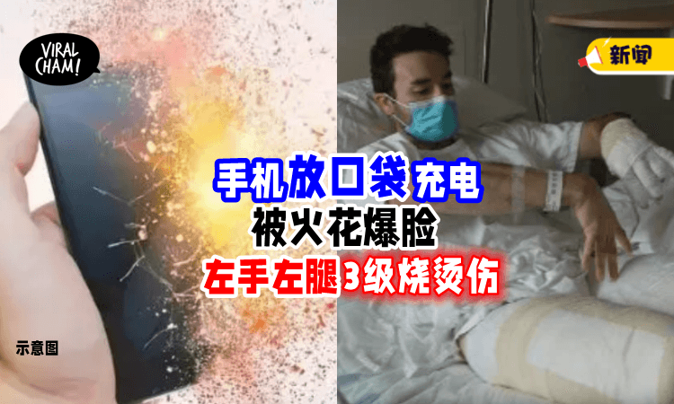【传出嘶嘶声】手机放口袋充电「突然爆炸💥」造成男子3级烧伤🔥