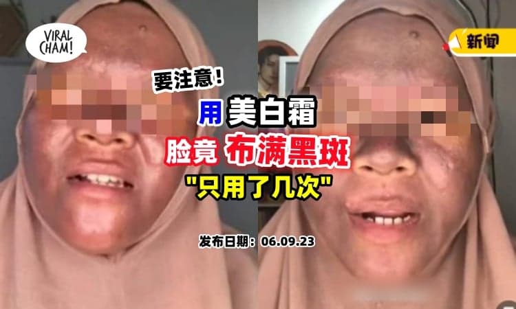 【买护肤品要注意❗】女子使用「美白霜」整张脸变黑黑，竟是它造成的！
