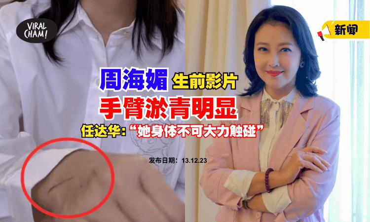 【网友翻出❗】周海媚生前影片『手臂淤青明显』⚡ 任达华回应：她身体不可大力触碰！