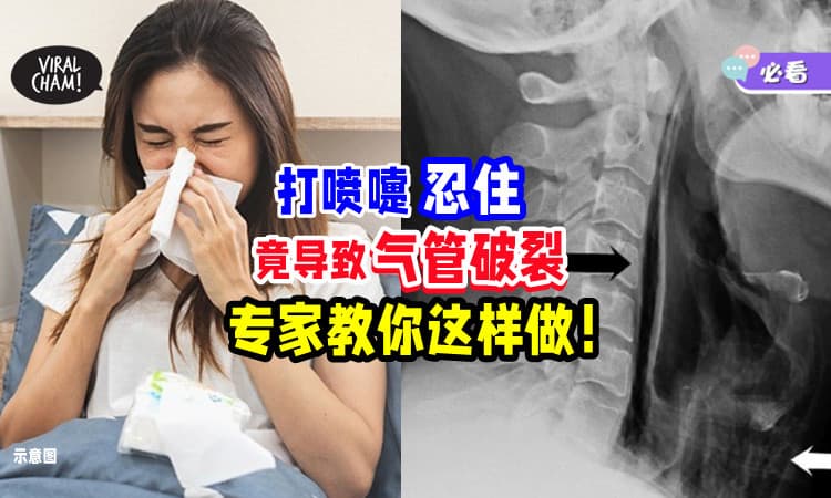【不要Tahan着🤧】忍住不打喷嚏竟导致「气管破洞💥」专家教你这样做！