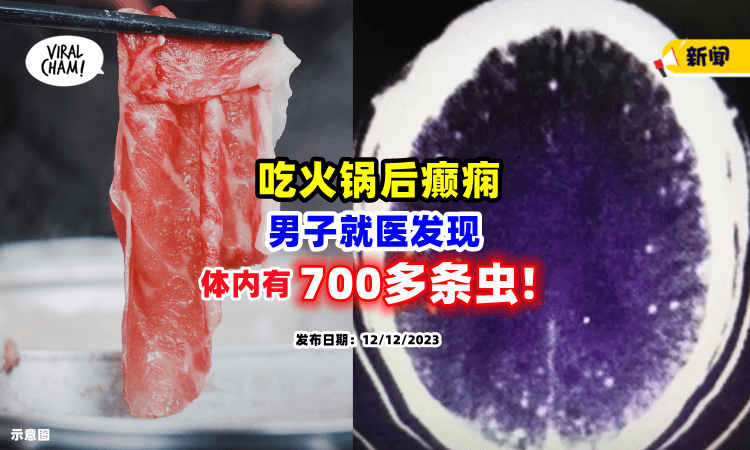 【好吓人😱】男子吃麻辣锅后癫痫发作，医生检查「惊见700多条虫🪱」