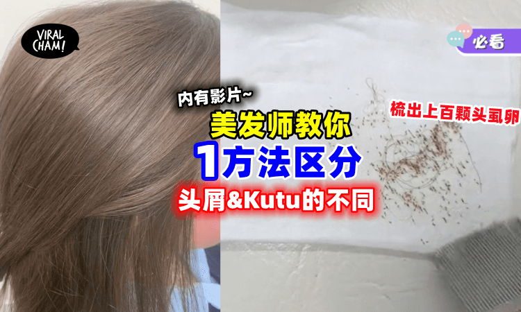 【超吓人❗】女子秀发藏「上百颗头虱卵😱」美发师教你区分Kutu和头屑！