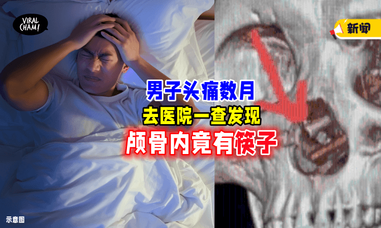 【头痛了几个月⚡】男子看医生发现「颅骨藏筷子🥢」原因让人超震惊！