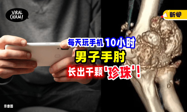【完全不能伸直❗️】26岁男子「每天熬夜打Game」手肘竟长出千颗“珍珠”😱