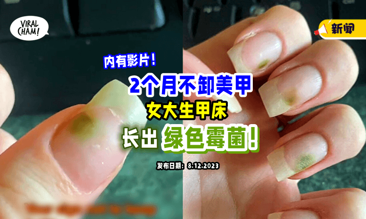 【不舍得卸掉💅】女大生「2个月没卸美甲」竟长出“绿色霉菌”😱