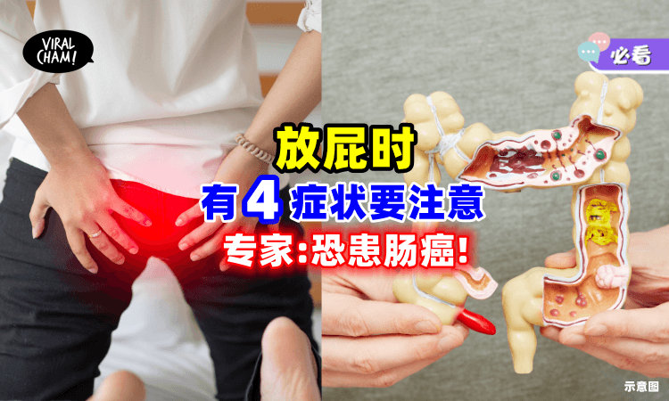 【不要忽视❗】放屁能够反映身体状况💨 专家：有这「4症状」恐患肠癌！