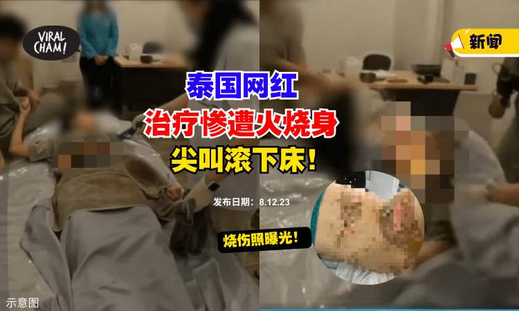 【烧伤照曝光🔥】泰国网红做传统治疗法，遭『火烧全身』尖叫滚下床⚡