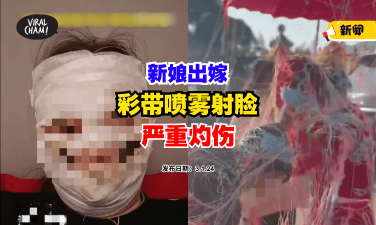 【婚闹差点毁容❗】新娘被『彩带喷雾射脸』冒白烟严重灼伤⚡ (内有影片)