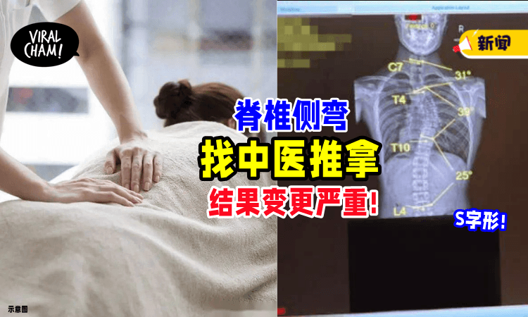 【情况变更糟⚡】找中医推拿3个月「脊椎侧弯」反而更严重❗️