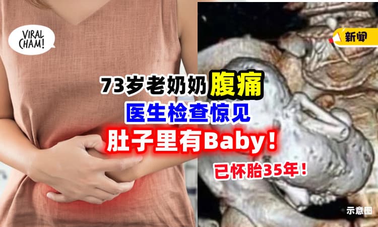 【怀胎35年😱】73岁老奶奶「腹痛送医⚡」医生发现她肚子里有Baby！