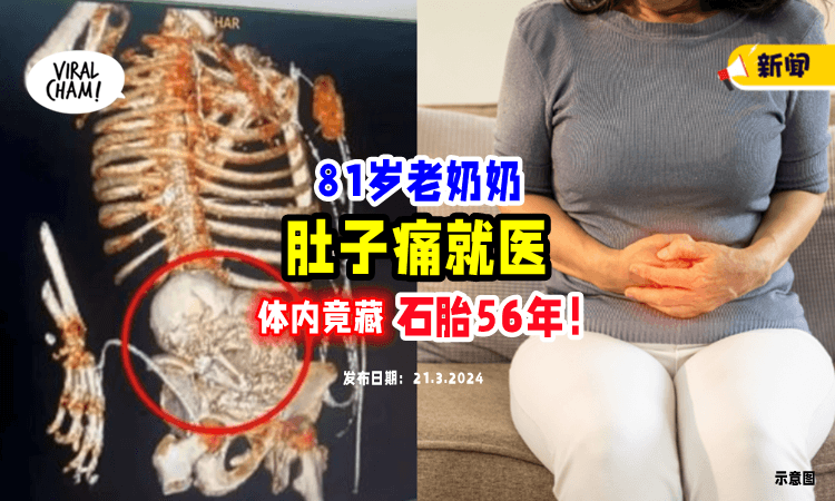 【肚子一直不舒服❗️】81岁阿嬷就医惊见「体内怀石胎」56年😱 取出仍不幸身亡！